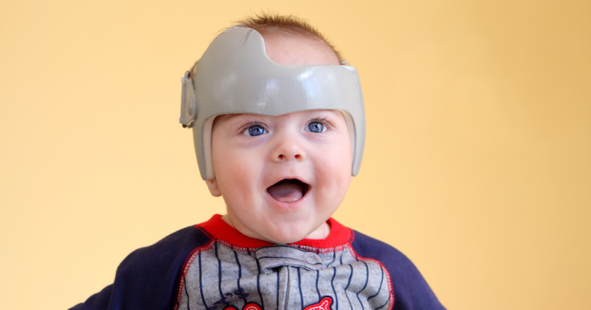Bébé portant un casque pour corriger la plagiocéphalie